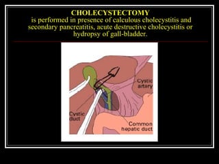 CHOLECYSTECTOMY
is performed in presence of calculous cholecystitis and
secondary pancreatitis, acute destructive cholecystitis or
hydropsy of gall-bladder.
 
