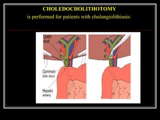 CHOLEDOCHOLITHOTOMY
is performed for patients with cholangiolithiasis:
 