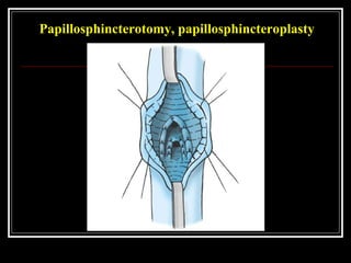 Papillosphincterotomy, papillosphincteroplasty
 