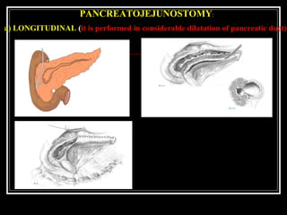 PANCREATOJEJUNOSTOMY:
a) LONGITUDINAL (it is performed in considerable dilatation of pancreatic duct)
 