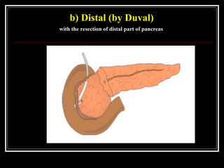 b) Distal (by Duval)
with the resection of distal part of pancreas
 