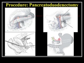 Procedure: Pancreatoduodenectomy
 