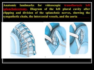 Anatomic landmarks for videoscopic transthoracic left
splanchnicectomy. Diagram of the left plural cavity after
clipping and division of the splanchnic nerves, showing the
sympathetic chain, the intercostal vessels, and the aorta
 