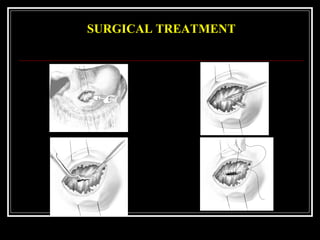 SURGICAL TREATMENT
 
