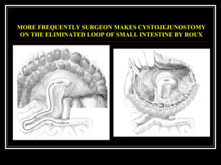 MORE FREQUENTLY SURGEON MAKES CYSTOJEJUNOSTOMY
ON THE ELIMINATED LOOP OF SMALL INTESTINE BY ROUX
 