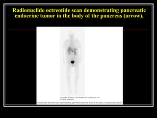Radionuclide octreotide scan demonstrating pancreatic
endocrine tumor in the body of the pancreas (arrow).
 
