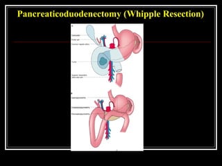 Pancreaticoduodenectomy (Whipple Resection)
 