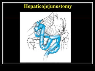 Hepaticojejunostomy
 