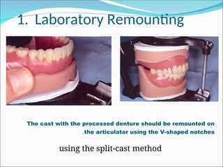 1. Laboratory Remounting
using the split-cast method
The cast with the processed denture should be remounted on
the articulator using the V-shaped notches
.
 