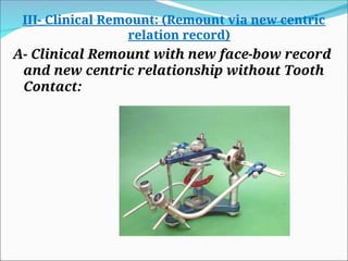III- Clinical Remount: (Remount via new centric
relation record)
A- Clinical Remount with new face-bow record
and new centric relationship without Tooth
Contact:
 