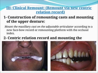 III- Clinical Remount: (Remount via new centric
relation record)
1- Construction of remounting casts and mounting
of the upper denture:
Mount the maxillary cast on the adjustable articulator according to a
new face-bow record or remounting platform with the occlusal
index.
2- Centric relation record and mounting the
mandibular denture:
 