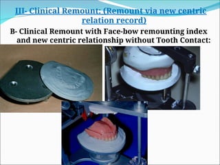 III- Clinical Remount: (Remount via new centric
relation record)
B- Clinical Remount with Face-bow remounting index
and new centric relationship without Tooth Contact:
 