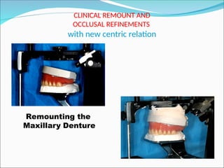 CLINICAL REMOUNT AND
OCCLUSAL REFINEMENTS
with new centric relation
Remounting the
Maxillary Denture
 