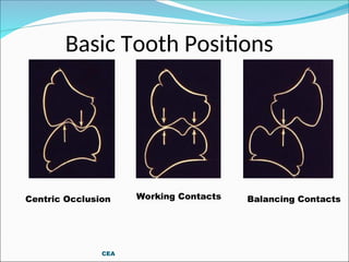 Basic Tooth Positions
CEA
Balancing Contacts
Centric Occlusion Working Contacts
 