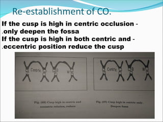-
If the cusp is high in centric occlusion
only deepen the fossa
.
-
If the cusp is high in both centric and
eccentric position reduce the cusp
.
 