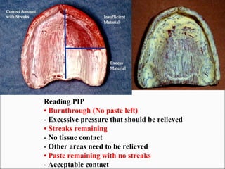 Reading PIP
• Burnthrough (No paste left)
- Excessive pressure that should be relieved
• Streaks remaining
- No tissue contact
- Other areas need to be relieved
• Paste remaining with no streaks
- Acceptable contact
 