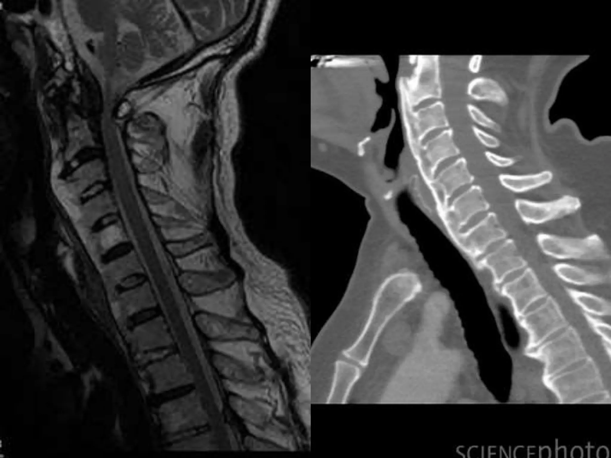 DISH: Diffuse Idiopathic Skeletal Hyperostosis of the spine | PPTX