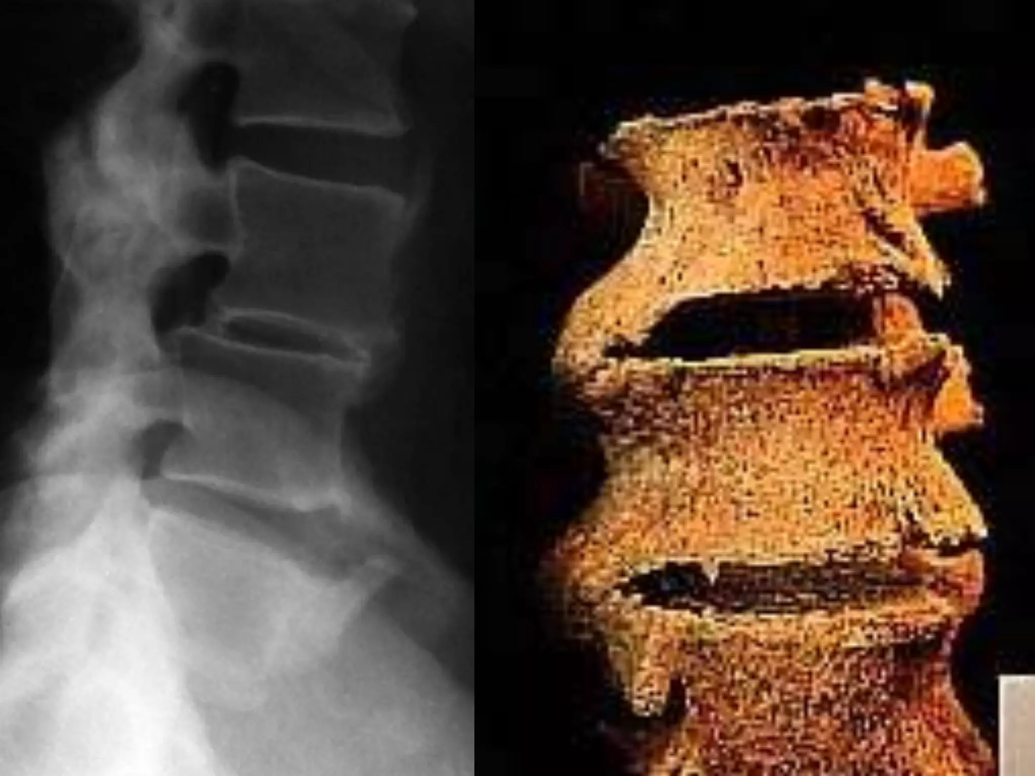 DISH: Diffuse Idiopathic Skeletal Hyperostosis of the spine | PPTX