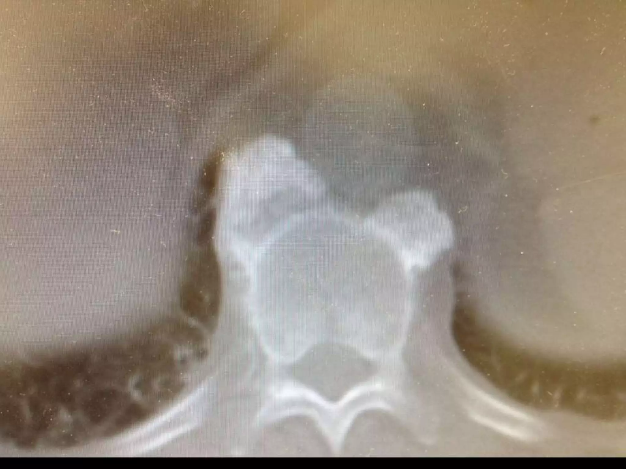 DISH: Diffuse Idiopathic Skeletal Hyperostosis of the spine | PPTX