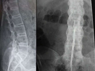DISH: Diffuse Idiopathic Skeletal Hyperostosis of the spine | PPTX
