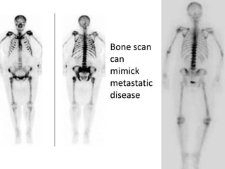 DISH: Diffuse Idiopathic Skeletal Hyperostosis of the spine | PPTX