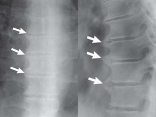 DISH: Diffuse Idiopathic Skeletal Hyperostosis of the spine | PPTX