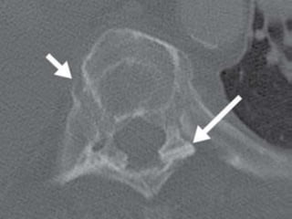 DISH: Diffuse Idiopathic Skeletal Hyperostosis of the spine | PPTX