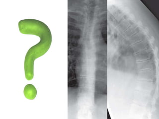 DISH: Diffuse Idiopathic Skeletal Hyperostosis of the spine | PPTX