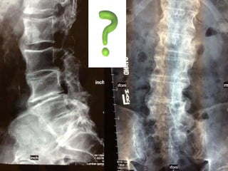 DISH: Diffuse Idiopathic Skeletal Hyperostosis of the spine | PPTX