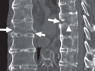 DISH: Diffuse Idiopathic Skeletal Hyperostosis of the spine | PPTX