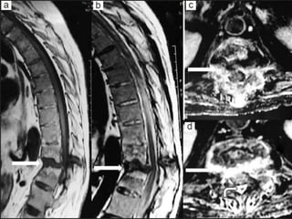 DISH: Diffuse Idiopathic Skeletal Hyperostosis of the spine | PPTX