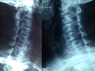 DISH: Diffuse Idiopathic Skeletal Hyperostosis of the spine | PPTX
