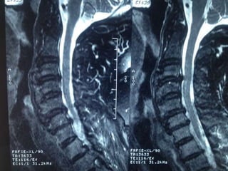 DISH: Diffuse Idiopathic Skeletal Hyperostosis of the spine | PPTX