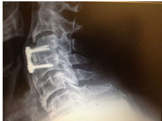 DISH: Diffuse Idiopathic Skeletal Hyperostosis of the spine | PPTX
