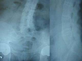 DISH: Diffuse Idiopathic Skeletal Hyperostosis of the spine | PPTX