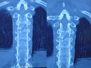 DISH: Diffuse Idiopathic Skeletal Hyperostosis of the spine | PPTX