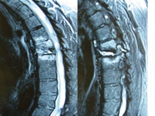 DISH: Diffuse Idiopathic Skeletal Hyperostosis of the spine | PPTX