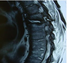 DISH: Diffuse Idiopathic Skeletal Hyperostosis of the spine | PPTX