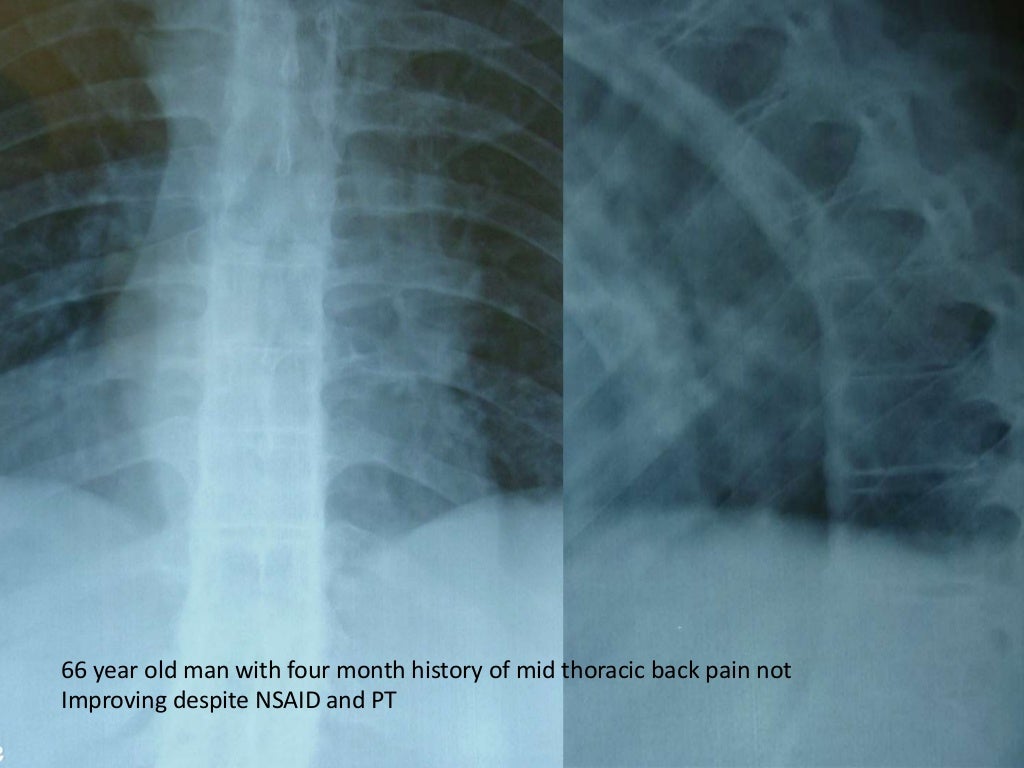 Diffuse Idiopathic Skeletal Hyperostosis – VJIPHE
