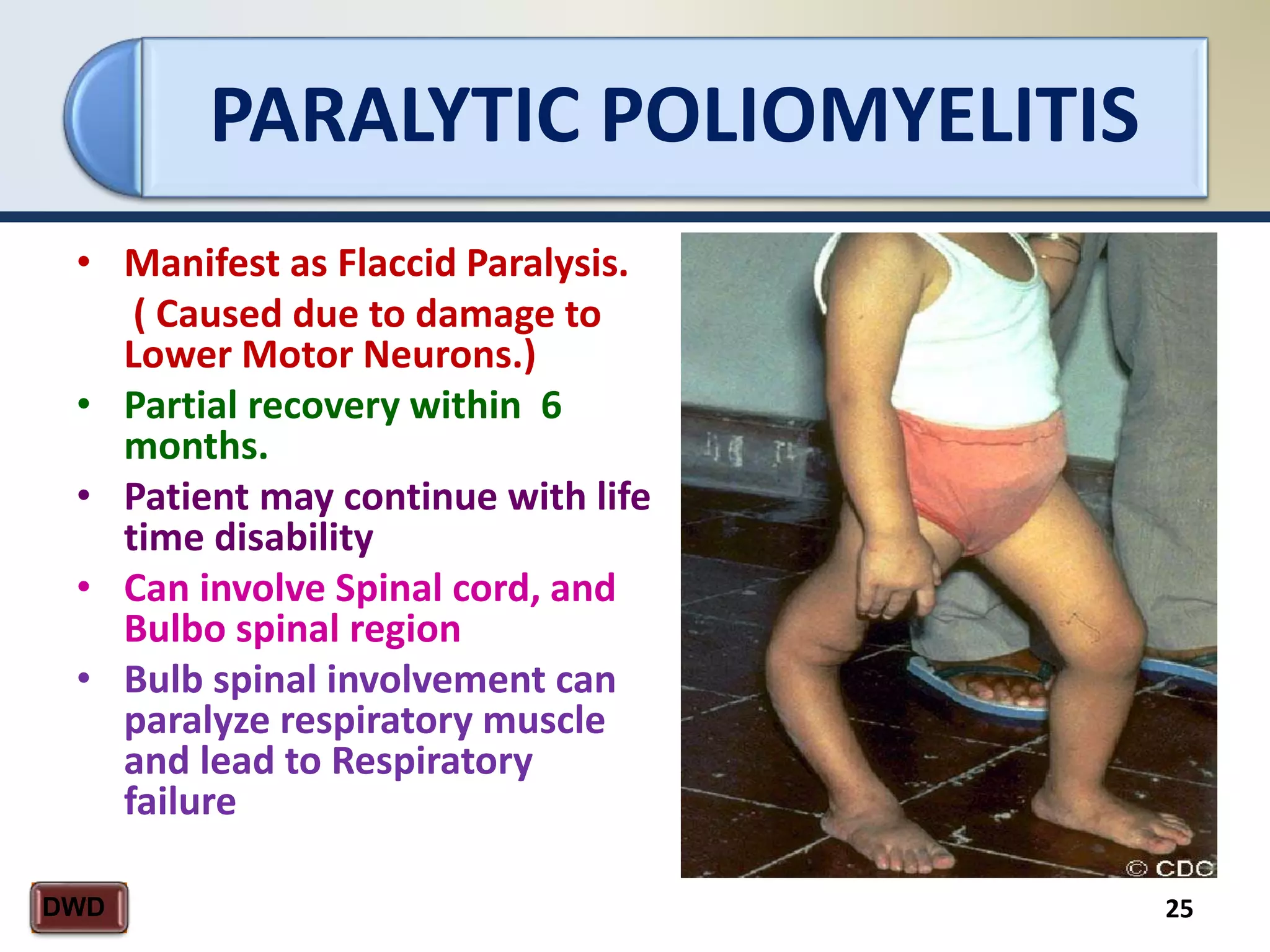 PARALYTIC POLIOMYELITIS
25DWD
• Manifest as Flaccid Paralysis.
( Caused due to damage to
Lower Motor Neurons.)
• Partial recovery within 6
months.
• Patient may continue with life
time disability
• Can involve Spinal cord, and
Bulbo spinal region
• Bulb spinal involvement can
paralyze respiratory muscle
and lead to Respiratory
failure