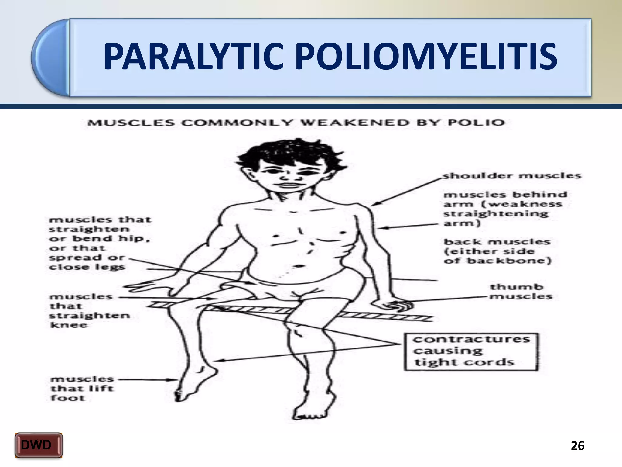 PARALYTIC POLIOMYELITIS
26DWD