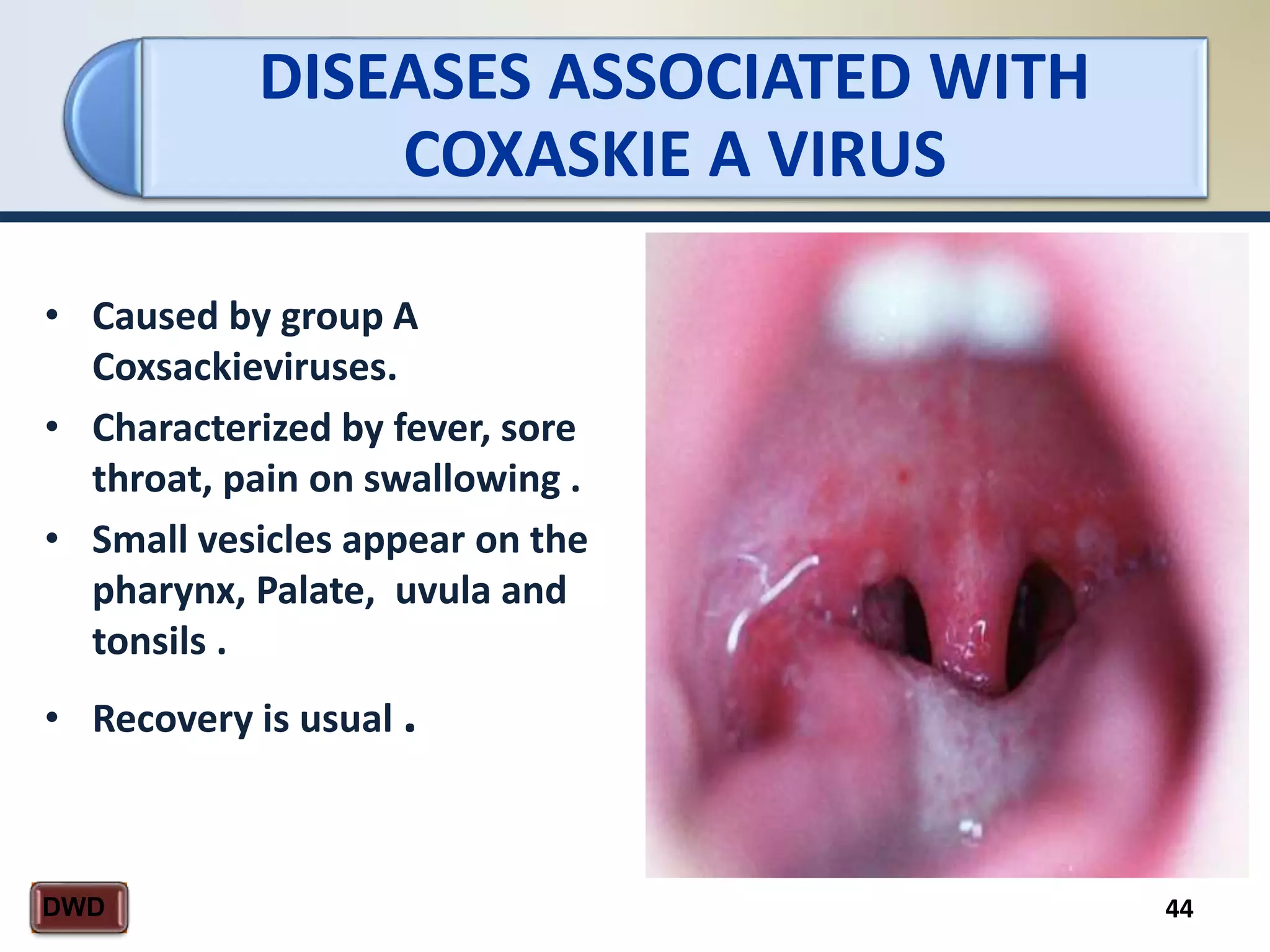 DISEASES ASSOCIATED WITH
COXASKIE A VIRUS
44DWD
• Caused by group A
Coxsackieviruses.
• Characterized by fever, sore
throat, pain on swallowing .
• Small vesicles appear on the
pharynx, Palate, uvula and
tonsils .
• Recovery is usual .
