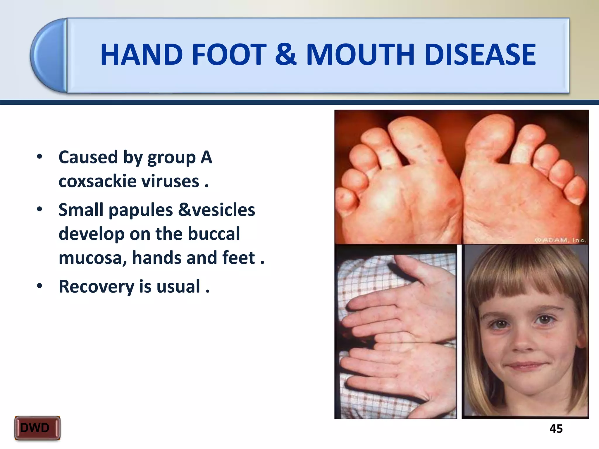 HAND FOOT & MOUTH DISEASE
45DWD
• Caused by group A
coxsackie viruses .
• Small papules &vesicles
develop on the buccal
mucosa, hands and feet .
• Recovery is usual .