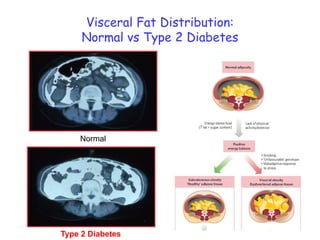 NormalType 2 DiabetesVisceral Fat Distribution:Normal vs Type 2 Diabetes