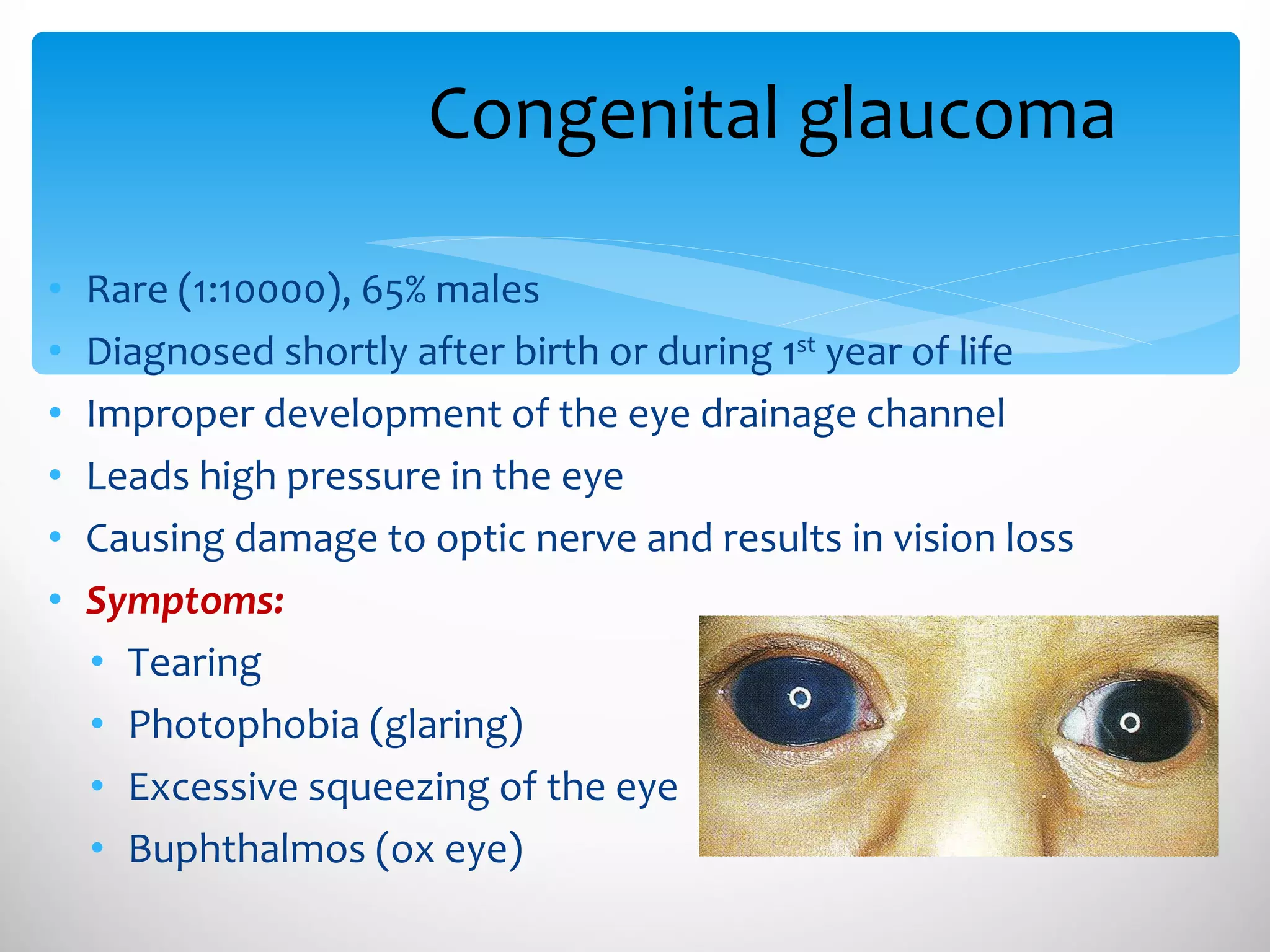 Congenital glaucoma Rare (1:10000), 65% males Diagnosed shortly after birth or during 1 st  year of life Improper development of the eye drainage channel Leads high pressure in the eye Causing damage to optic nerve and results in vision loss Symptoms: Tearing  Photophobia (glaring) Excessive squeezing of the eye Buphthalmos (ox eye) 