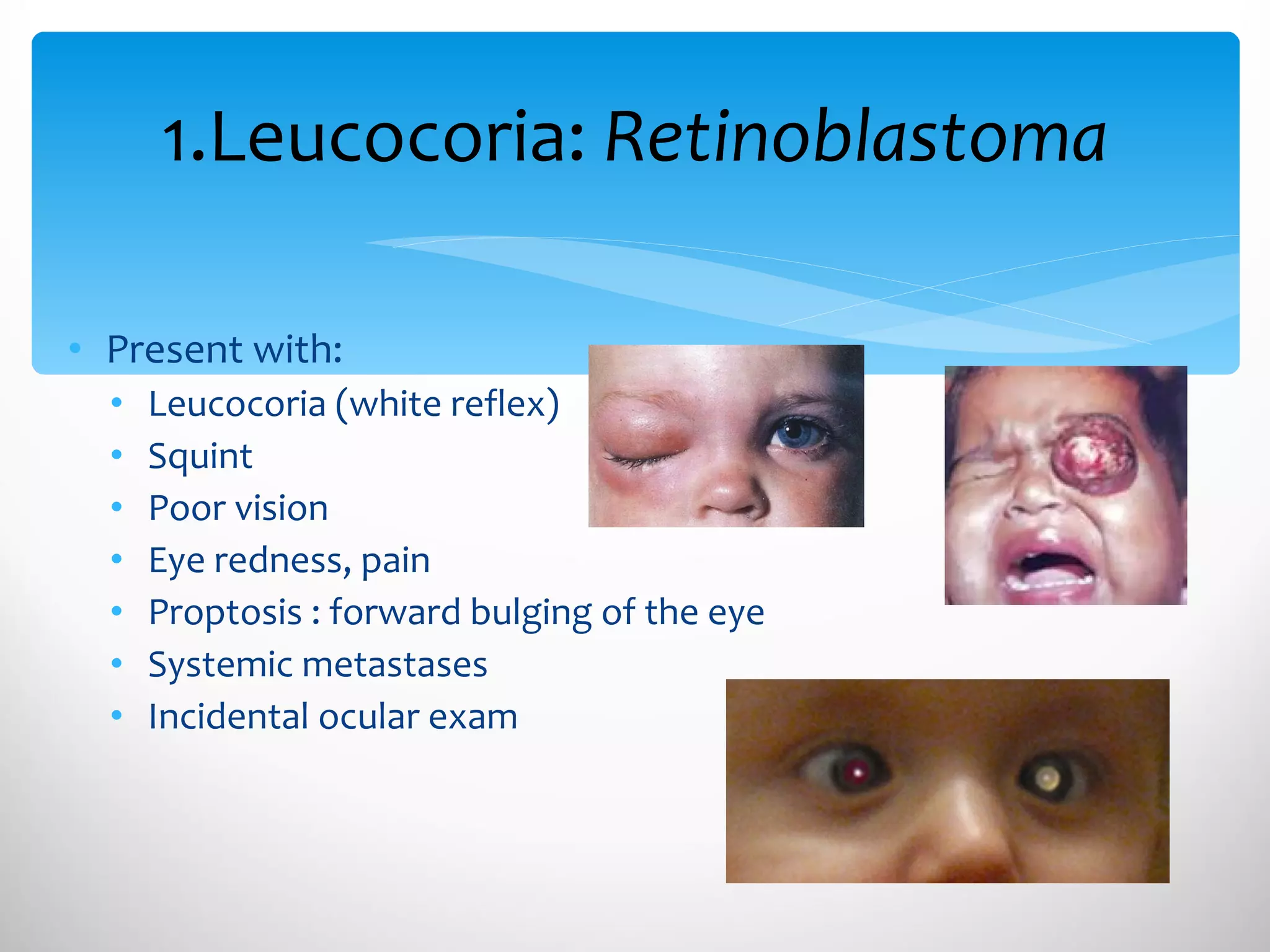 1.Leucocoria:  Retinoblastoma Present with: Leucocoria (white reflex) Squint  Poor vision Eye redness, pain Proptosis : forward bulging of the eye Systemic metastases Incidental ocular exam 
