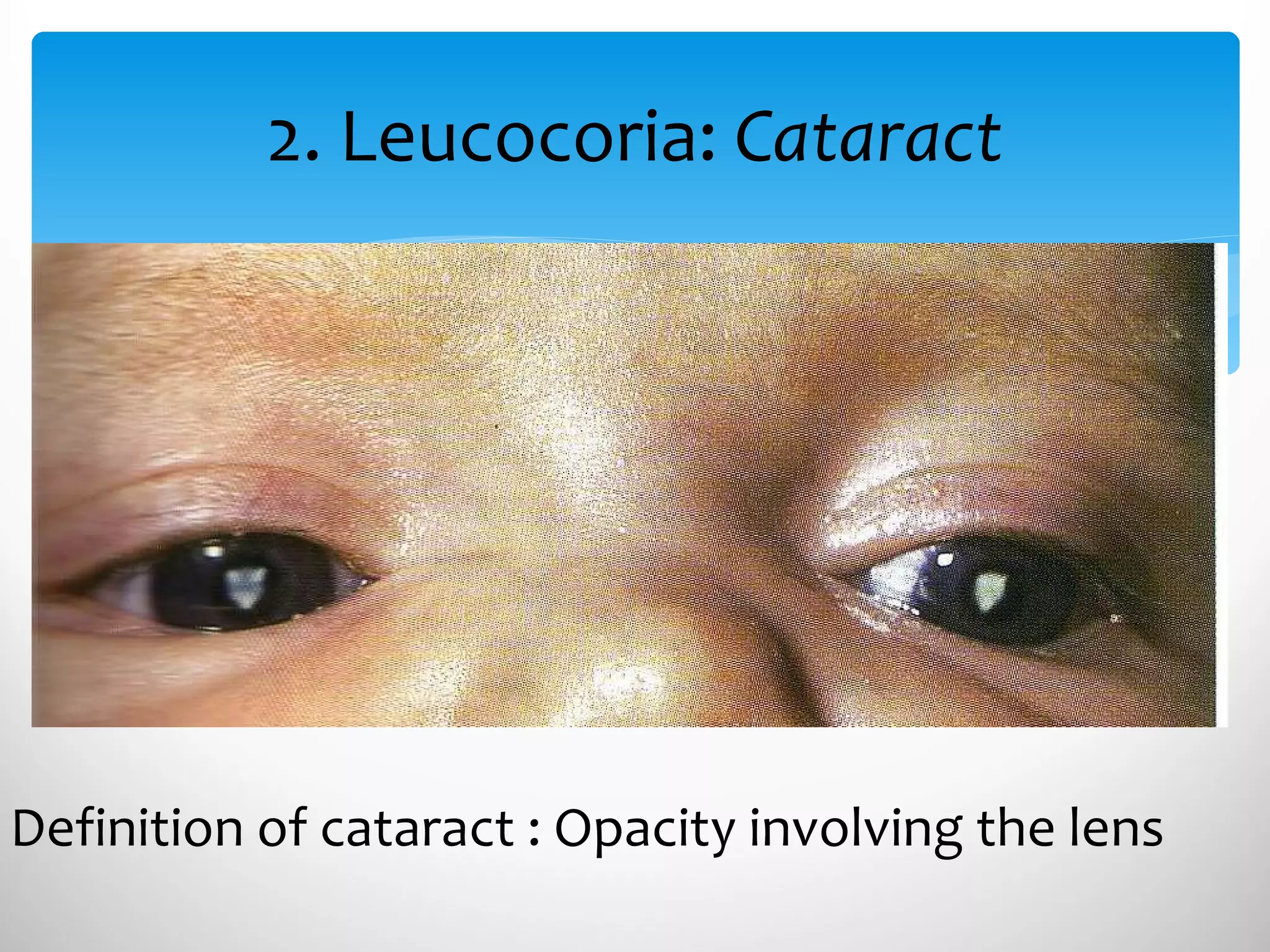 2. Leucocoria:  Cataract Definition of cataract : Opacity involving the lens 