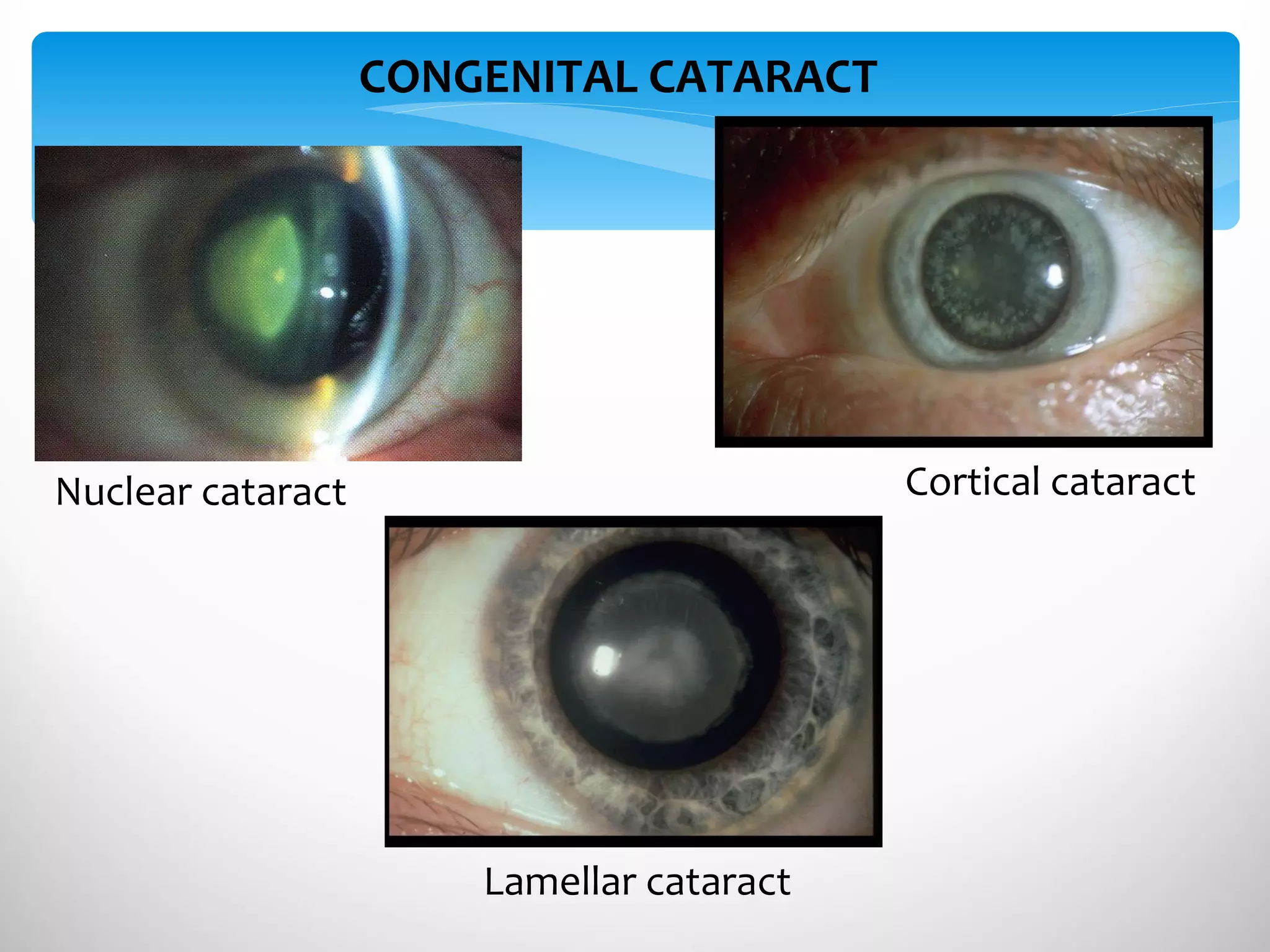 Nuclear cataract Lamellar cataract Cortical cataract CONGENITAL CATARACT 
