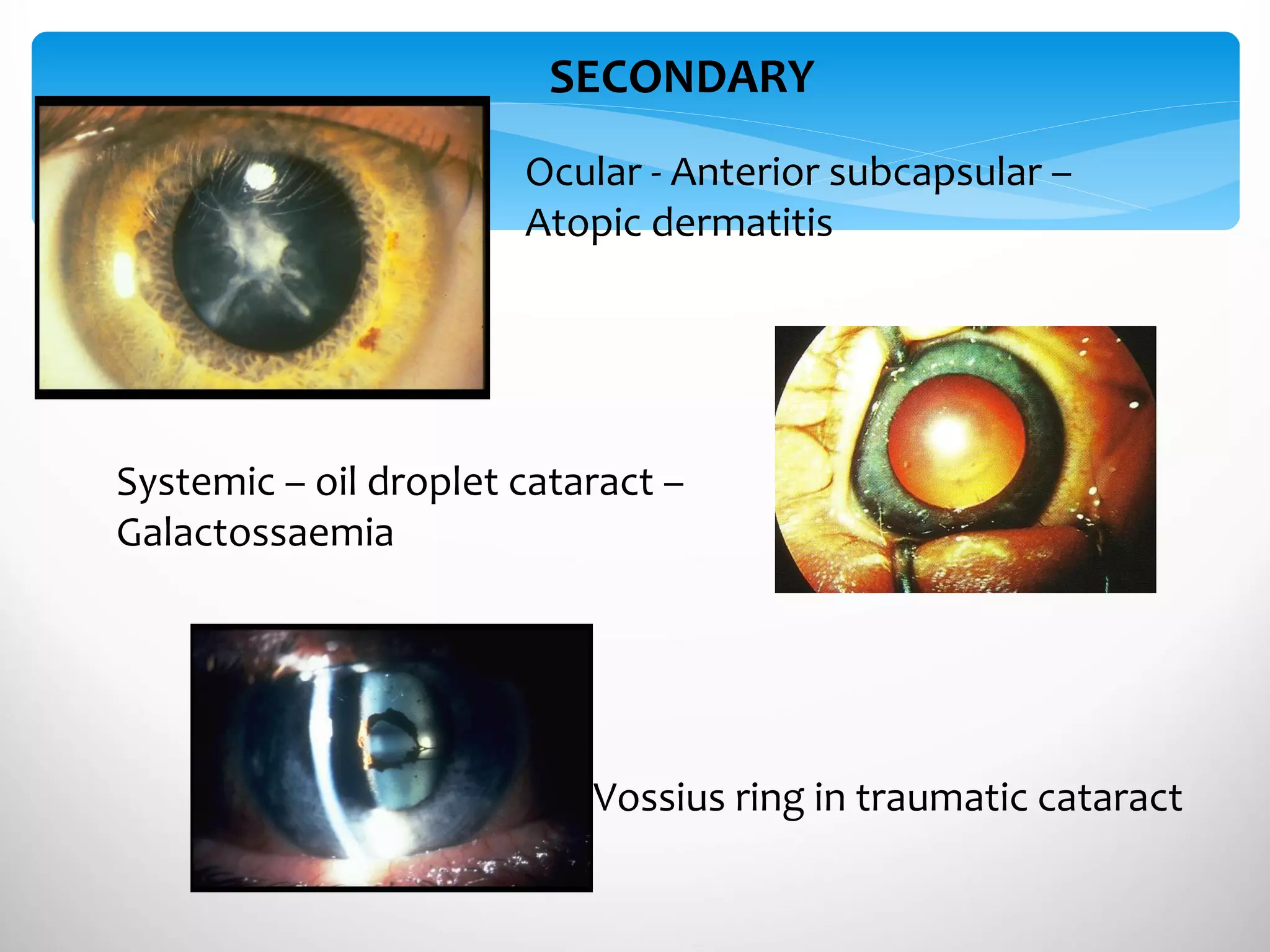 SECONDARY  Ocular - Anterior subcapsular –  Atopic dermatitis Systemic – oil droplet cataract –  Galactossaemia Vossius ring in traumatic cataract 