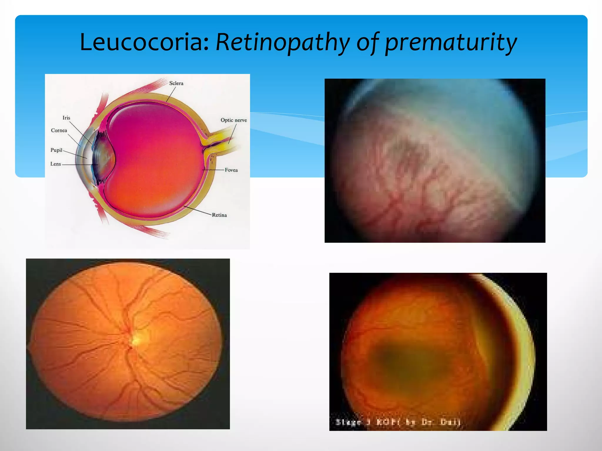 Leucocoria:  Retinopathy of prematurity  